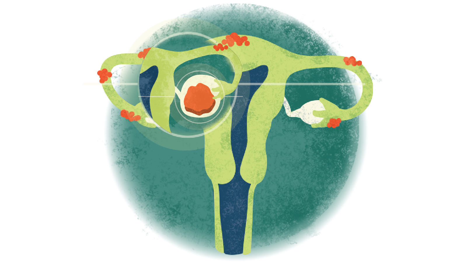 Illustration of an endometria in a circle over a uterus with endometriosis