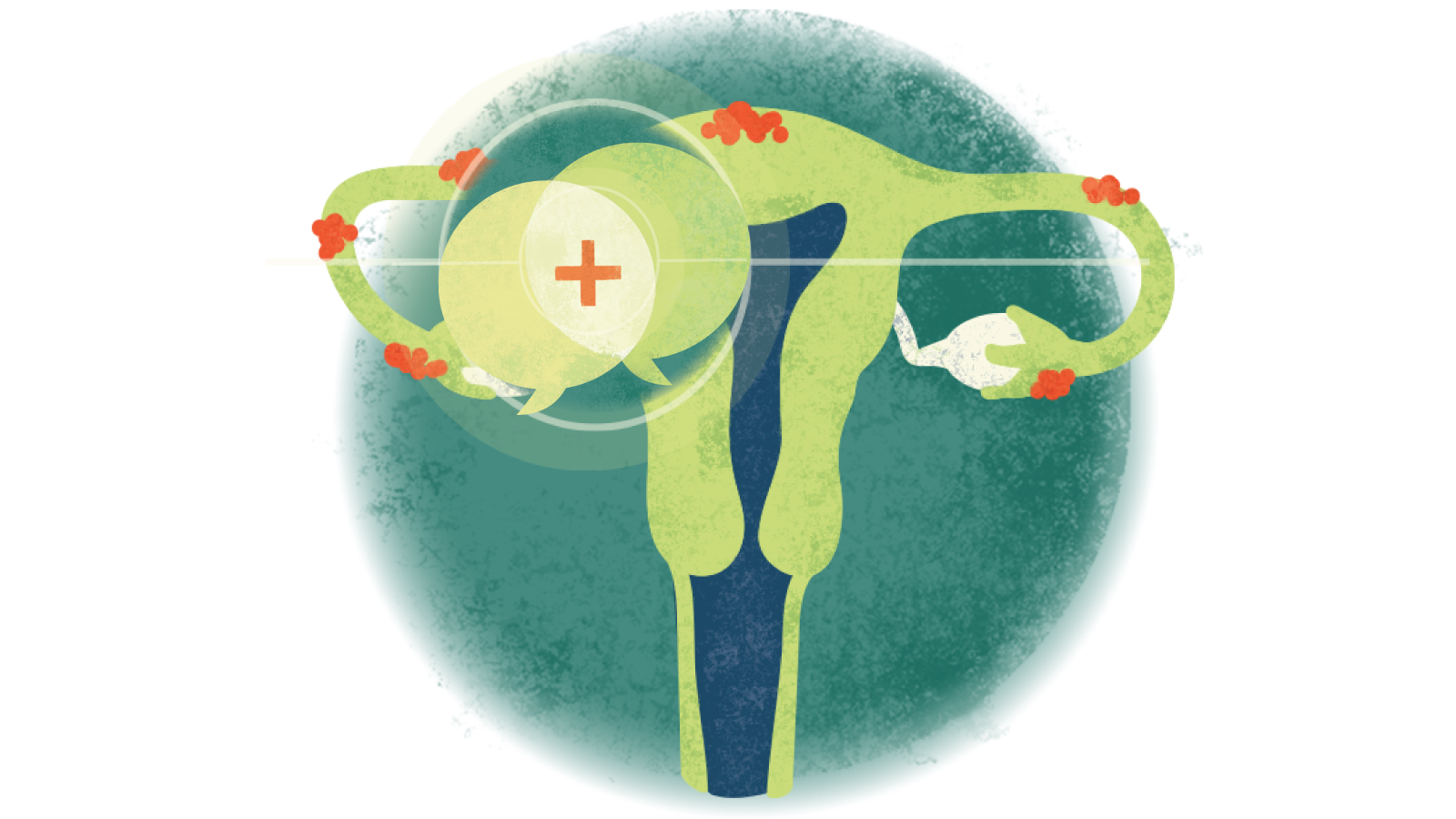 Illustration of two talking bubbles with a plus sign in the middle of them over a uterus with endometriosis