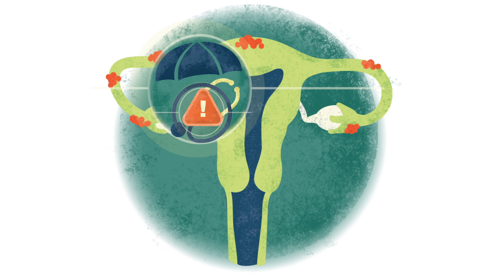 Illustration of an exclamation point in a triangle over a stethoscope in a circle over a uterus with endometriosis