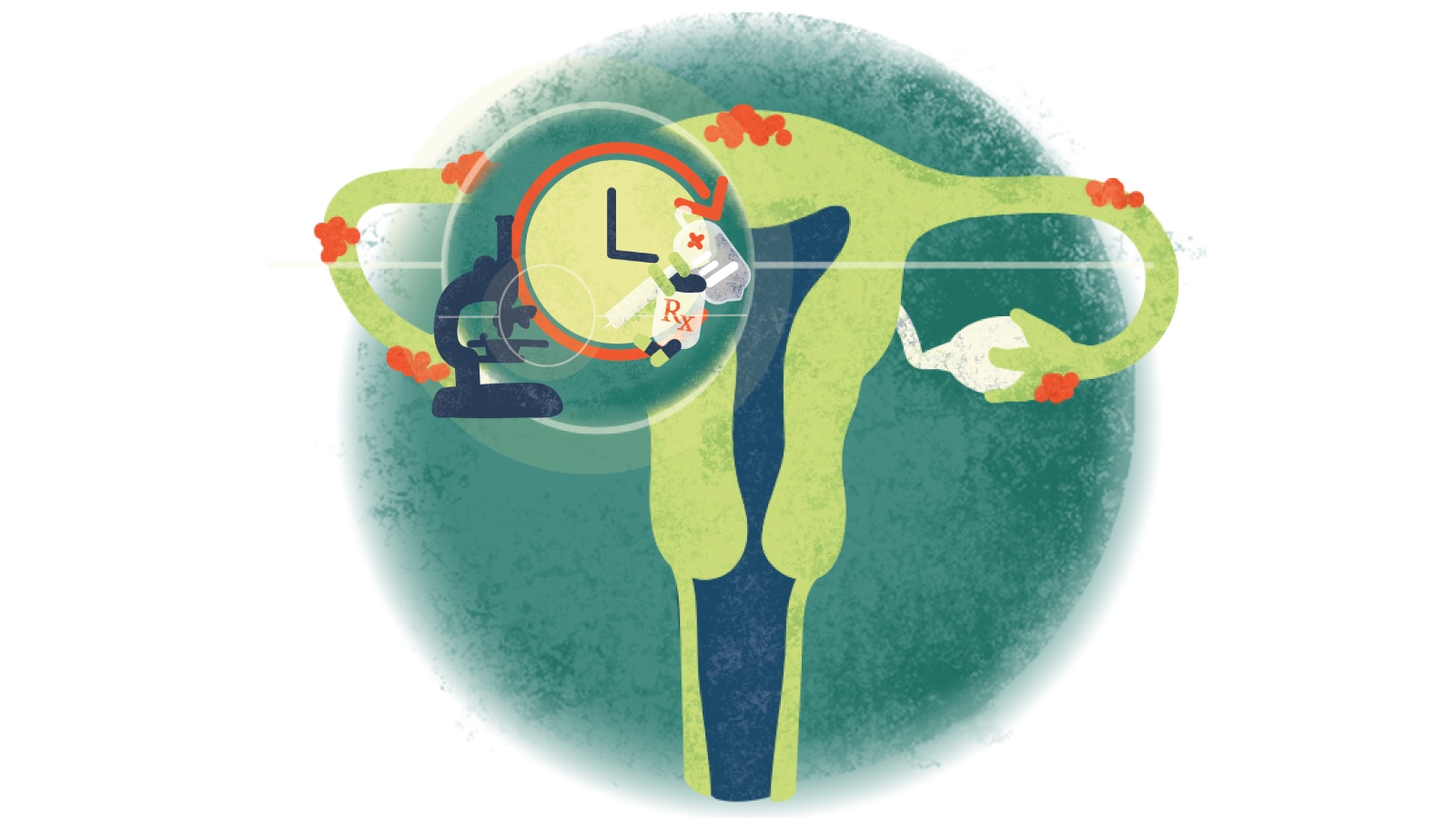 Illustration of an Rx bottle with pills, IV bag over a clock over a stethoscope in a circle over a uterus with endometriosis
