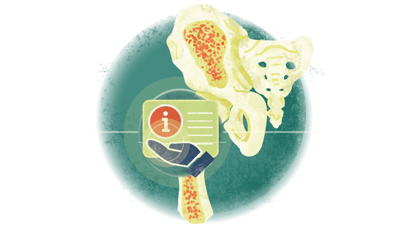 Illustration of the letter i over a hand over osteoporosis