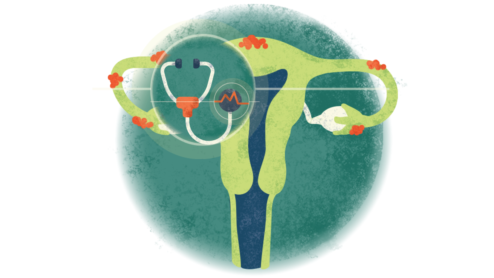 Illustration of a stethoscope with an electrocardiogram over a uterus with endometriosis