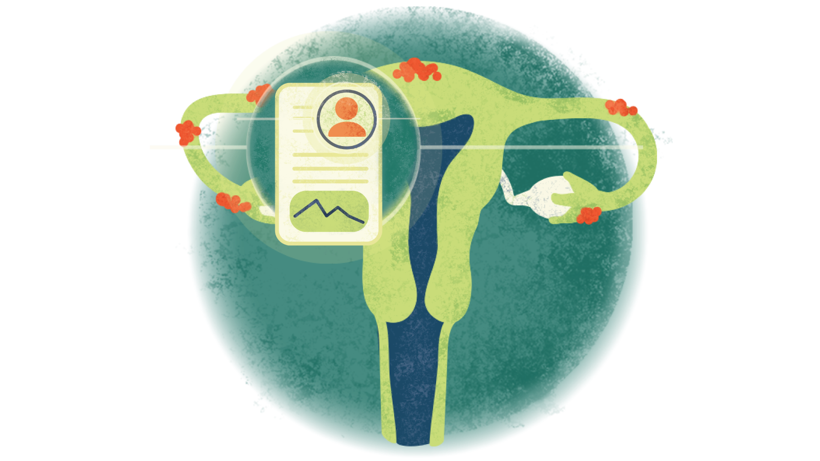 Illustration of a written case study over a uterus with endometriosis